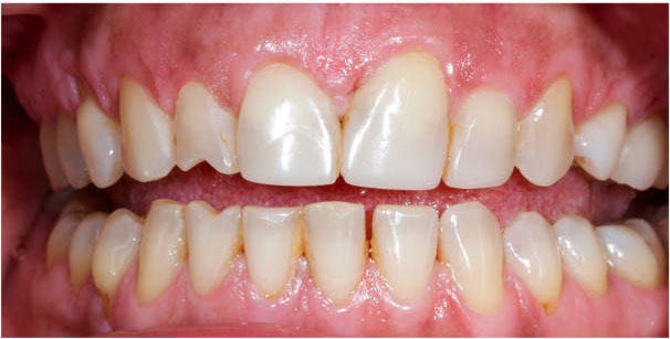 Smile after cosmetic dental treatment